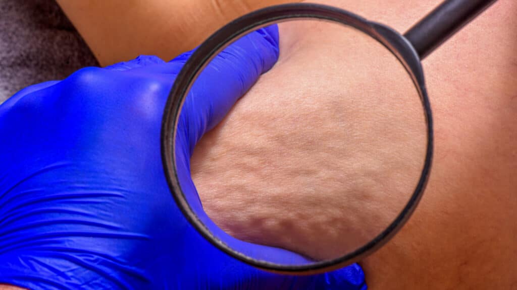 Cellulite in Men